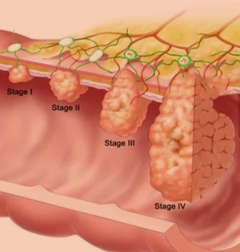 rates of colorectal cancer